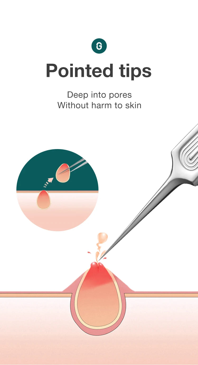 Precision Pointed Tweezers - Stainless Steel for Ingrown Hair, Splinters & Blackhead Removal