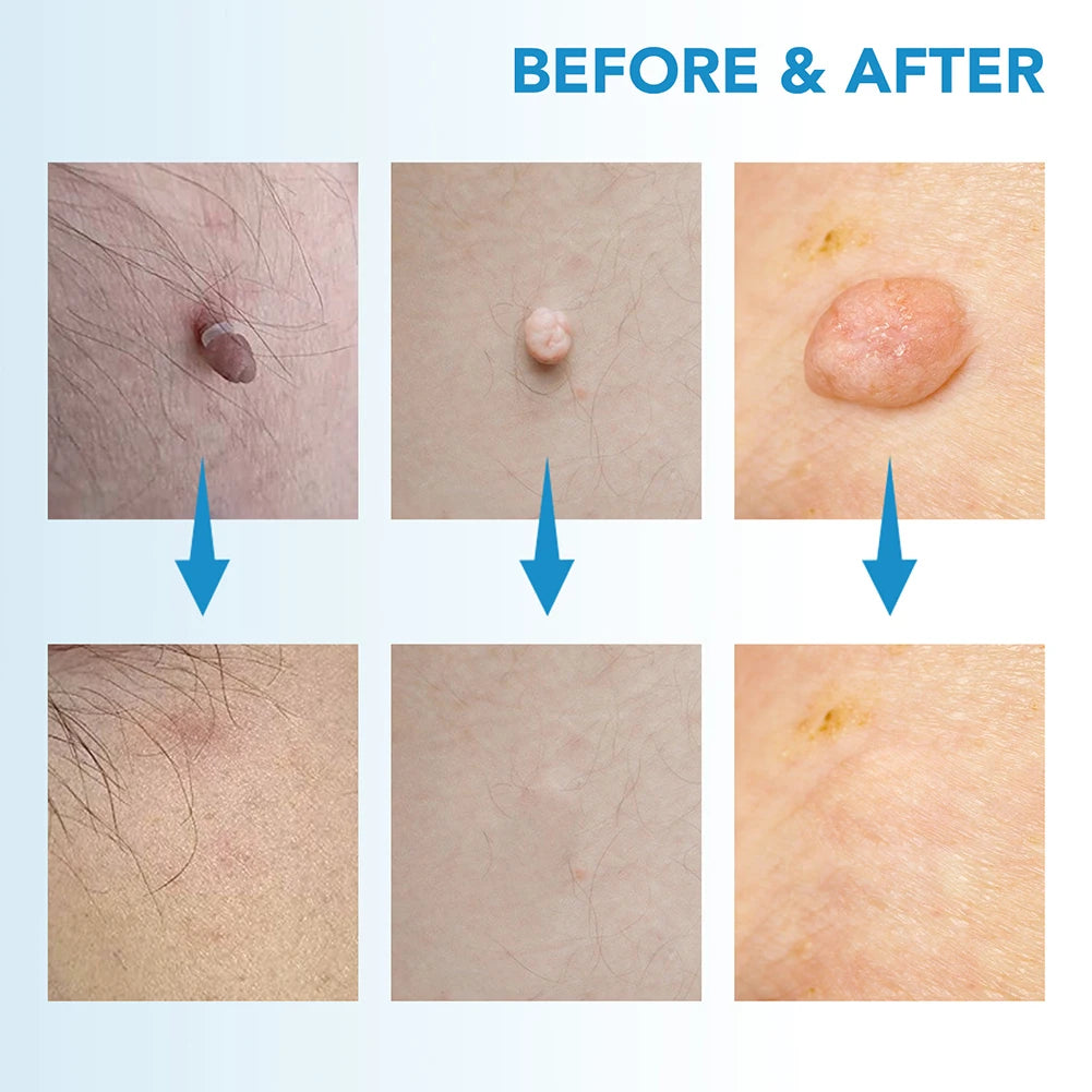 2-in-1 Skin Tag & Wart Remover Kit