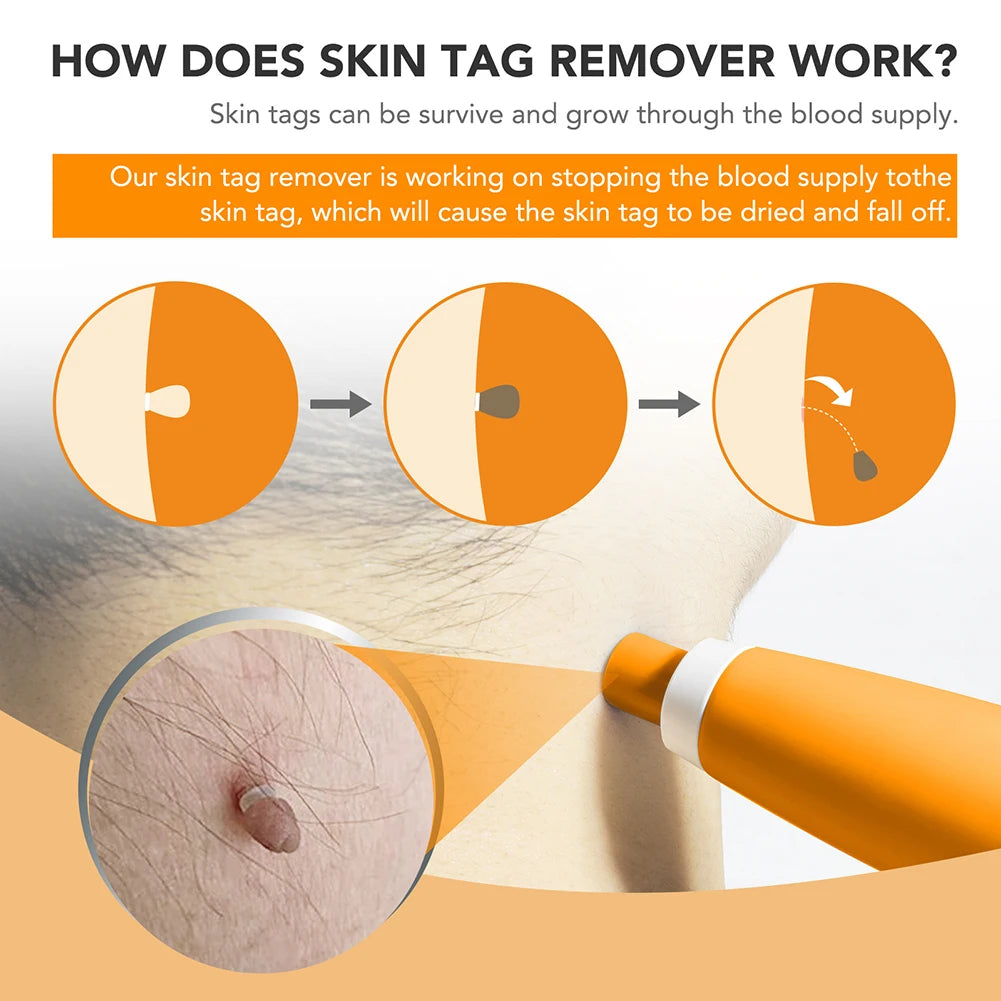2-in-1 Skin Tag & Wart Remover Kit