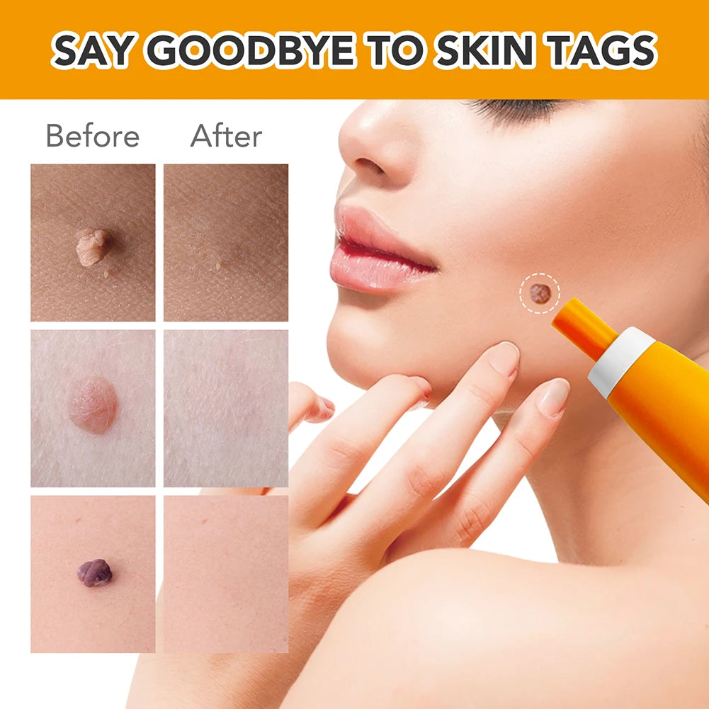 2-in-1 Skin Tag & Wart Remover Kit