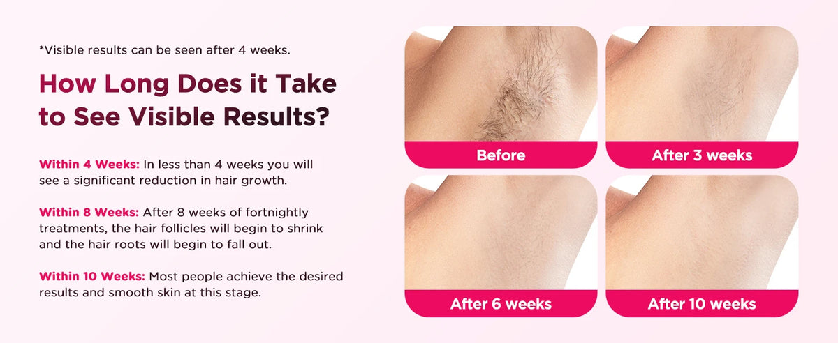 IPL Hair Removal Device with US Plug